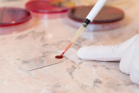 Rapid blood test can hasten treatment for stroke patients with brain bleeding