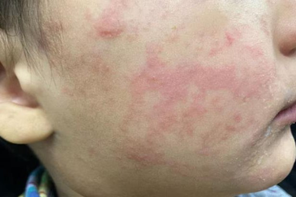 Measles cases in western Texas rise to 146, possibly spreading to other areas