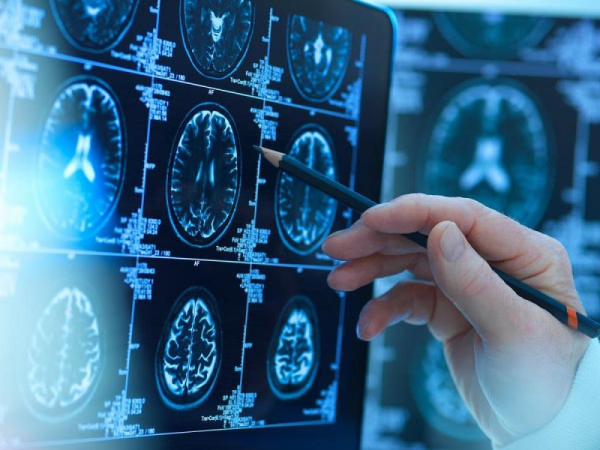 Researchers: Small traces of lithium may help prevent Alzheimer's