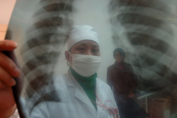 Heart disease risk linked to uterine fibroids